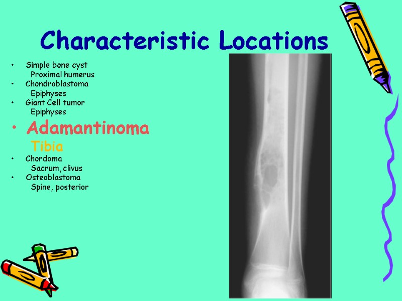 Simple bone cyst Proximal humerus Chondroblastoma Epiphyses Giant Cell tumor Epiphyses Adamantinoma Tibia Chordoma